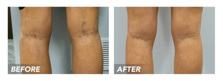 What would happen if I let my varicose veins go untreated, or if I seek treatment from an unreputable clinic? Highly trained varicose vein doctors in CT talk about five risks of not seeking treatment for varicose veins or getting treated in the wrong place.